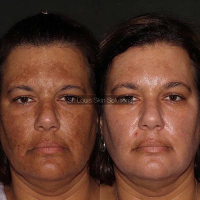 Chemical Peels Before & After Gallery - Patient 143733 - Image 1