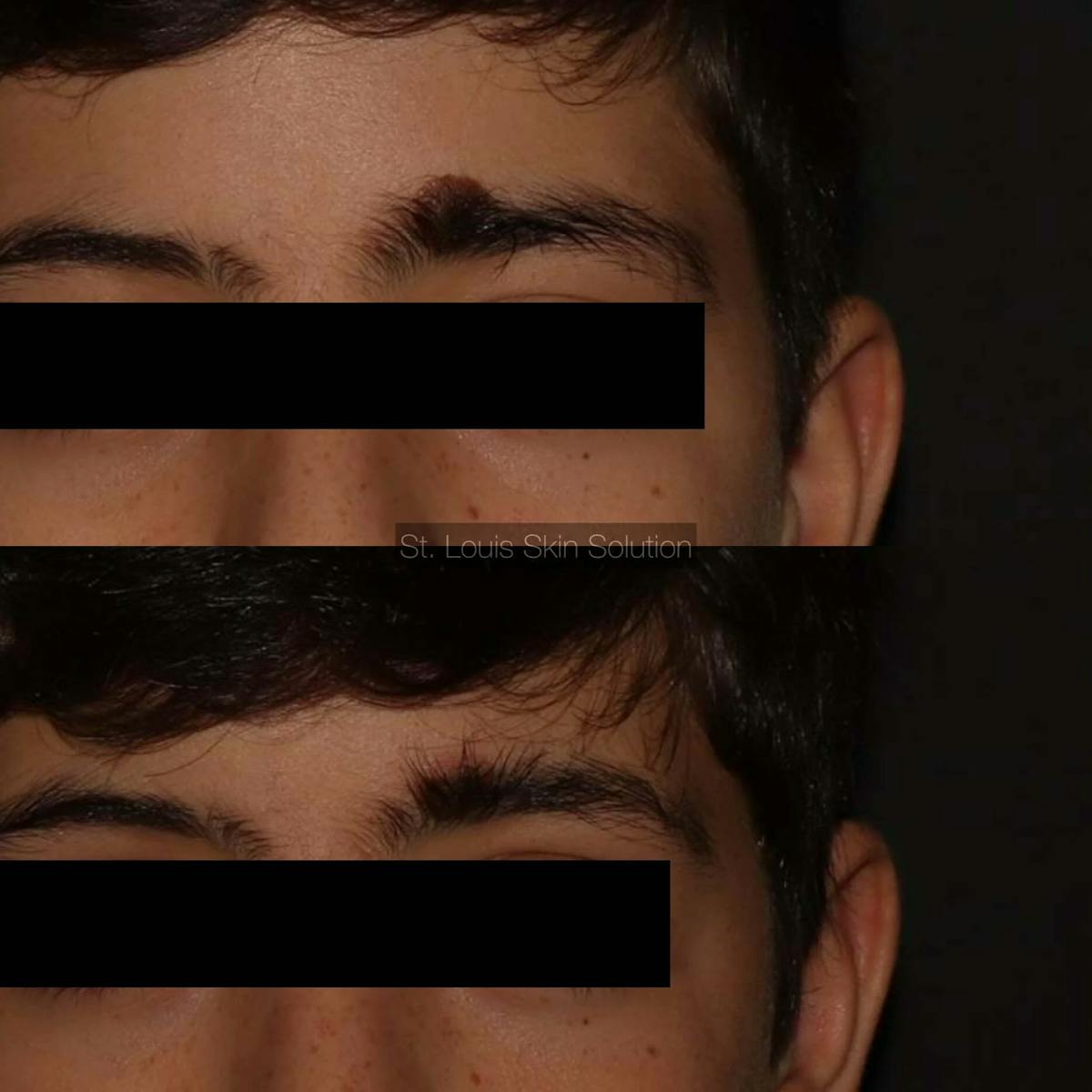 Lesion Removal Before & After Gallery - Patient 889121 - Image 1