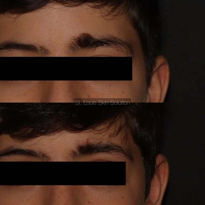 Lesion Removal Before & After Gallery - Patient 889121 - Image 1