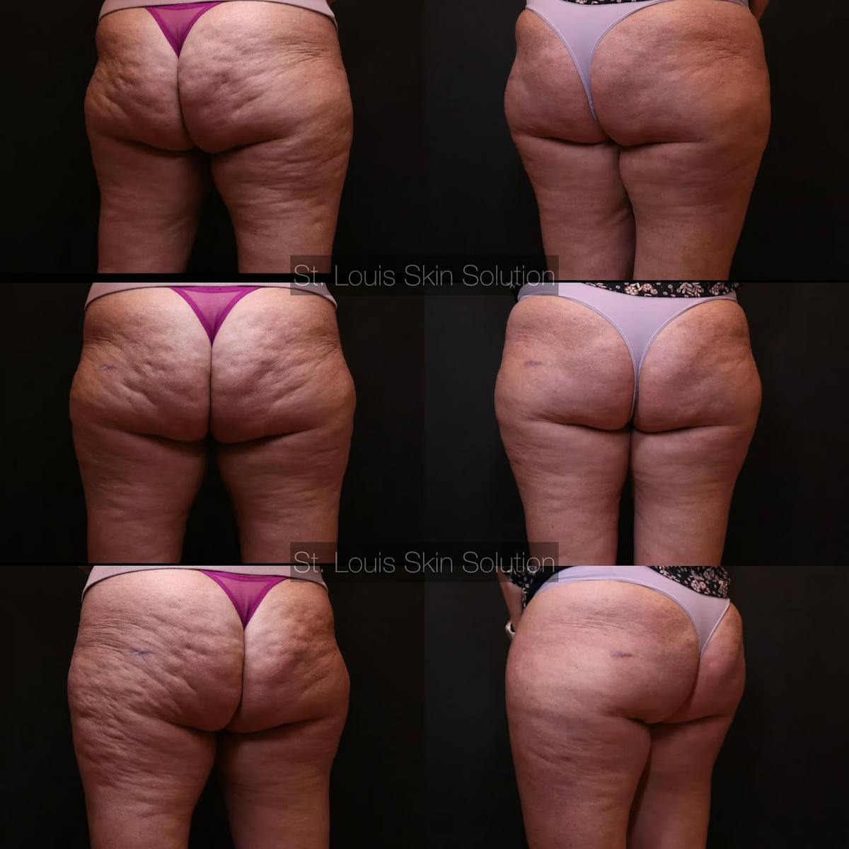 Cellulite Reduction Before & After Gallery - Patient 117509 - Image 1