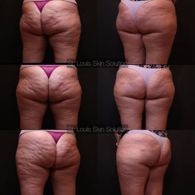 Cellulite Reduction Before & After Gallery - Patient 117509 - Image 1