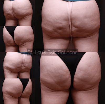 Cellulite Reduction Before & After Gallery - Patient 307386 - Image 1