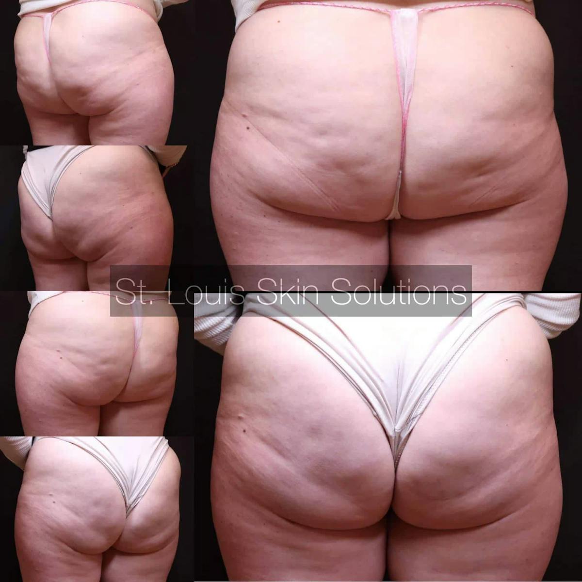 Cellulite Reduction Before & After Gallery - Patient 629271 - Image 1