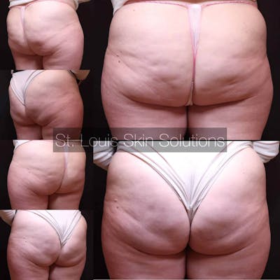 Cellulite Reduction Before & After Gallery - Patient 629271 - Image 1