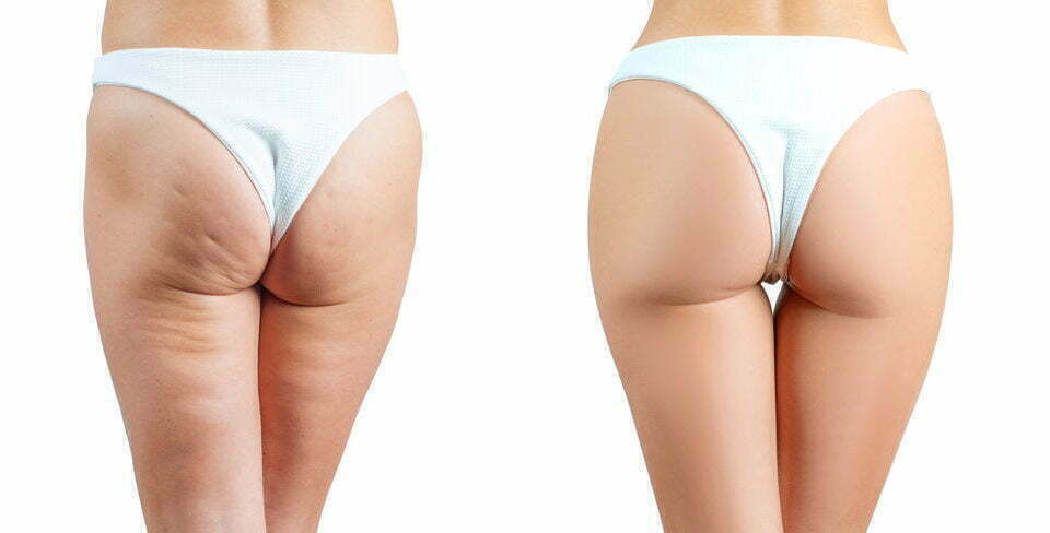 QWO Cellulite Treatment: Get Summer Ready