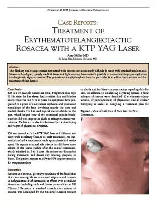 Treatment of Erythematotelangiectactic Rosacea with a KTP Yag Laser