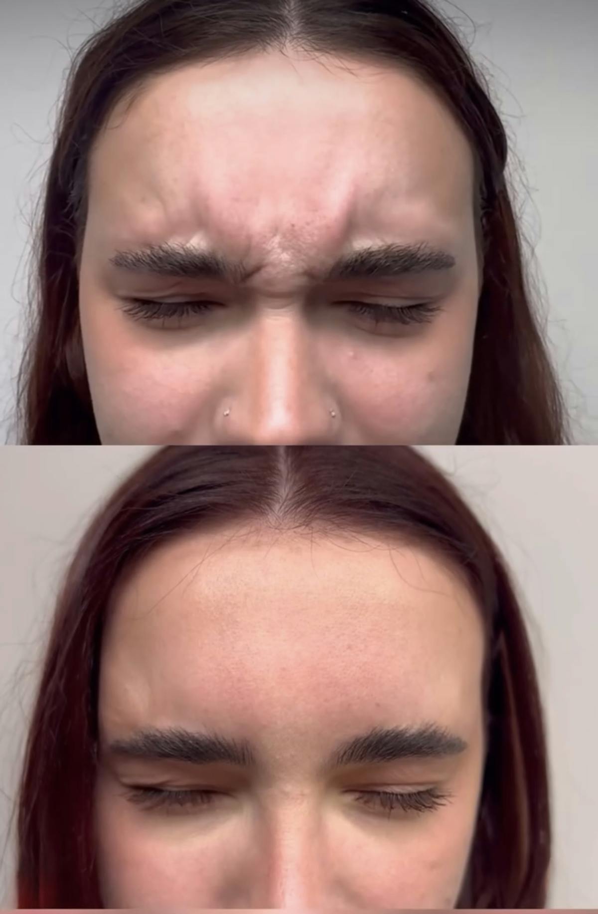 Neurotoxins Before & After Gallery - Patient 103733 - Image 1