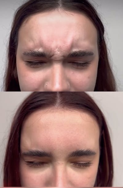 Neurotoxins Before & After Gallery - Patient 103733 - Image 1