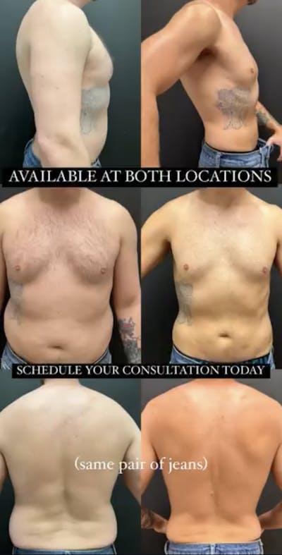 Weight Loss Before & After Gallery - Patient 186250 - Image 1