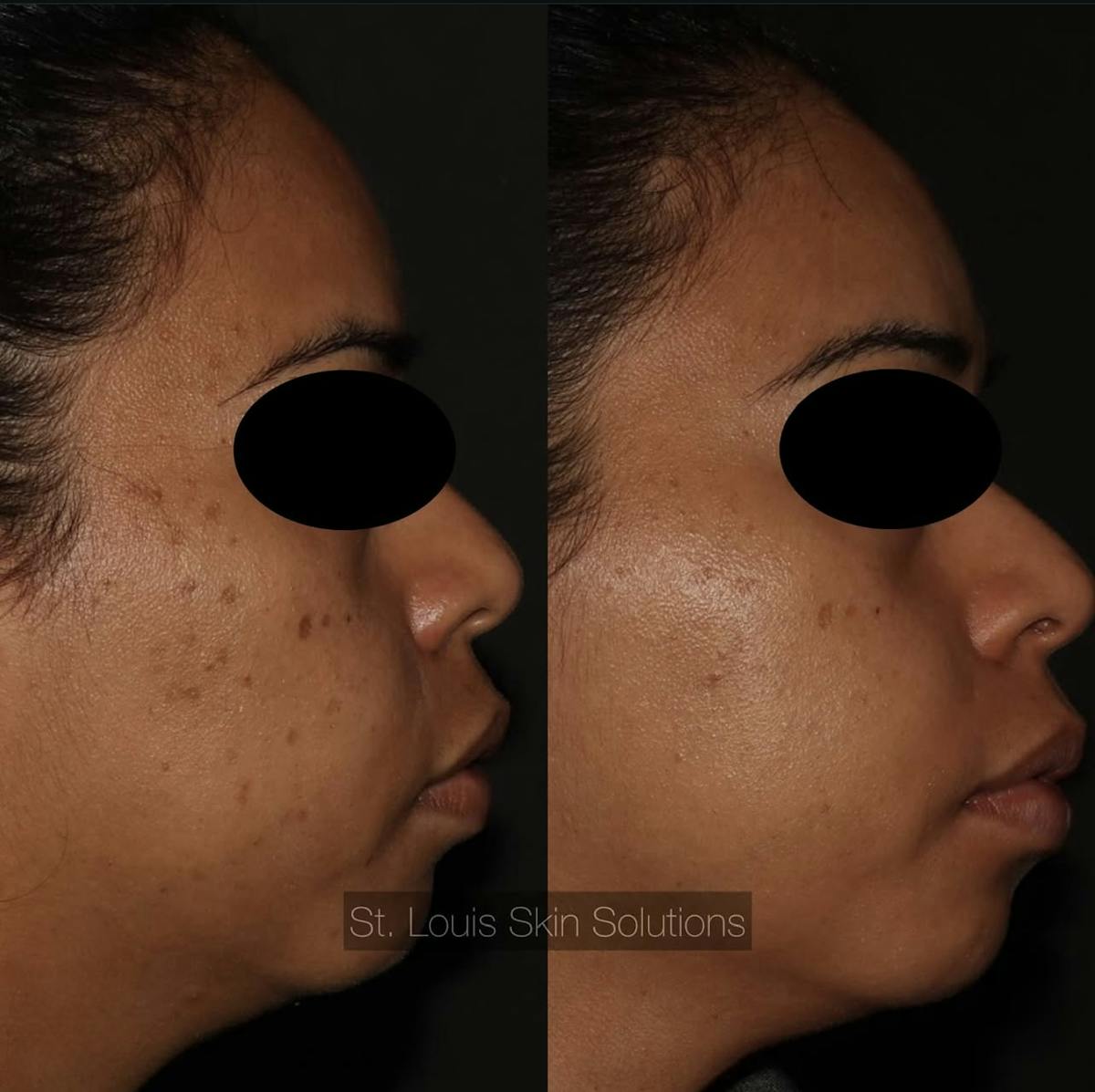 Acne Treatments Before & After Gallery - Patient 102255 - Image 1