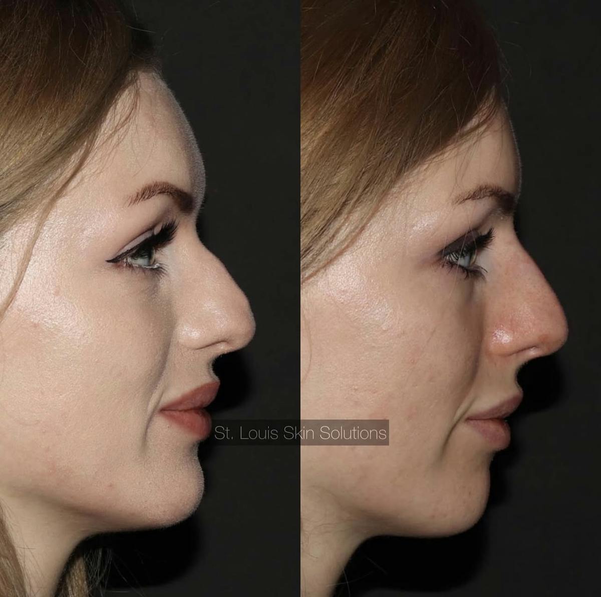 Fillers Before & After Gallery - Patient 126462 - Image 1