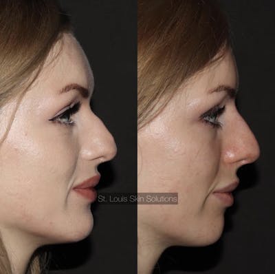 Fillers Before & After Gallery - Patient 126462 - Image 1
