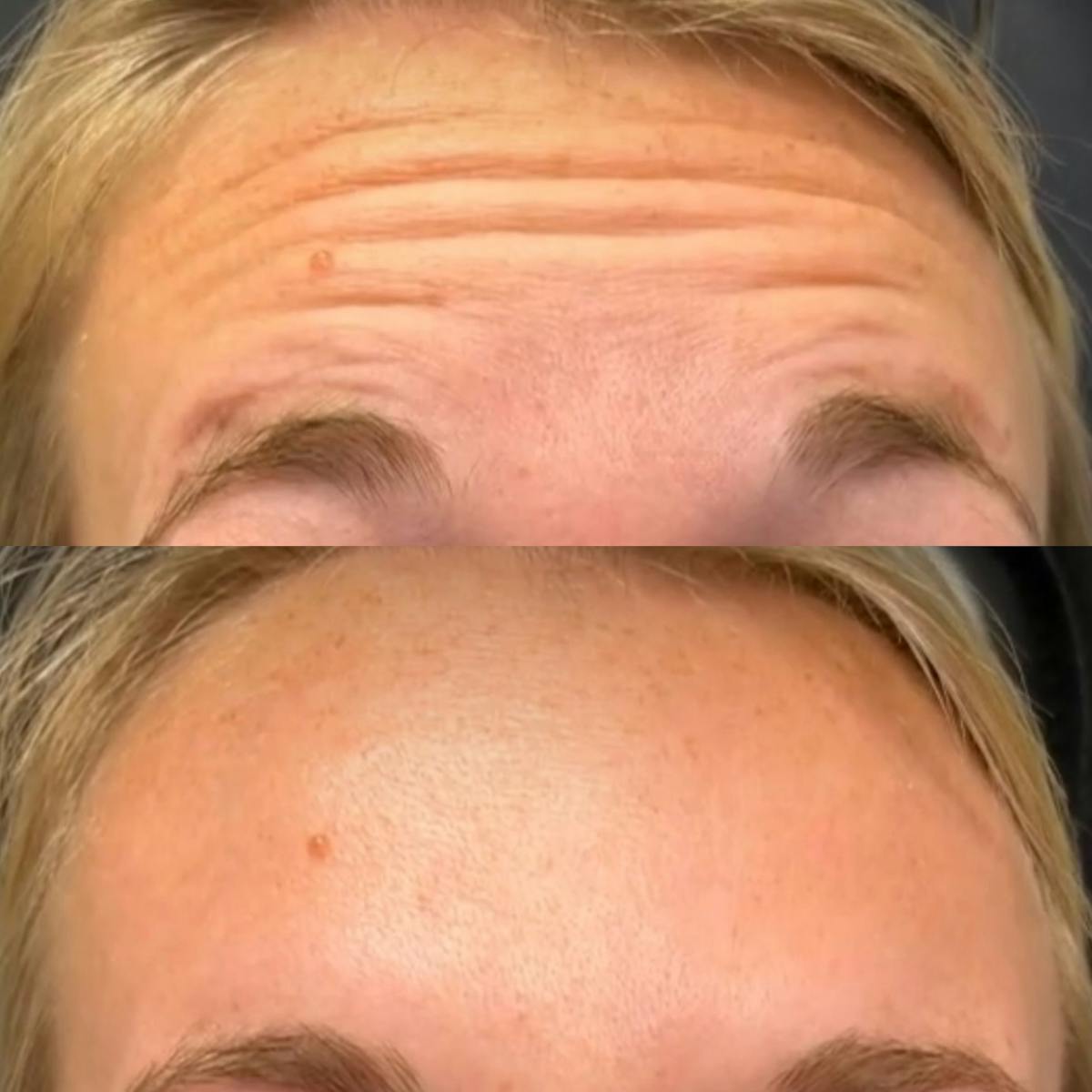 Neurotoxins Before & After Gallery - Patient 121966 - Image 1
