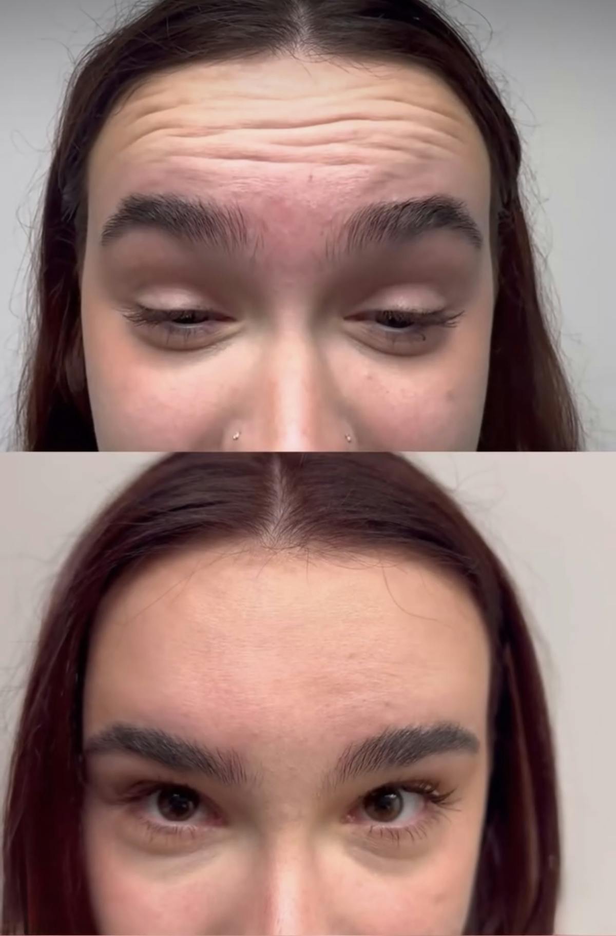 Neurotoxins Before & After Gallery - Patient 103733 - Image 2
