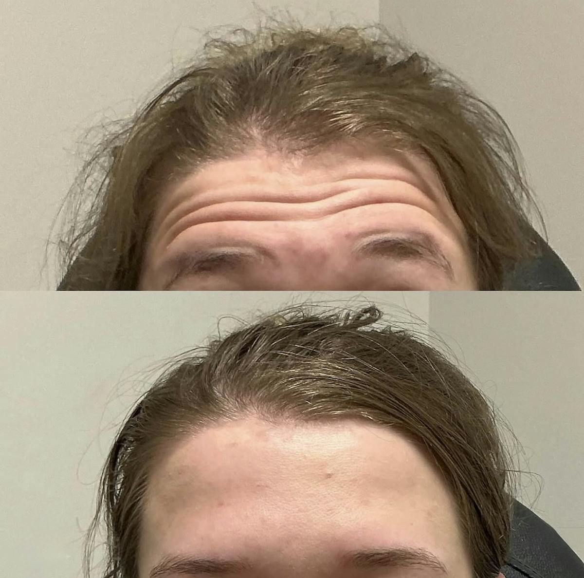 Neurotoxins Before & After Gallery - Patient 666194 - Image 3