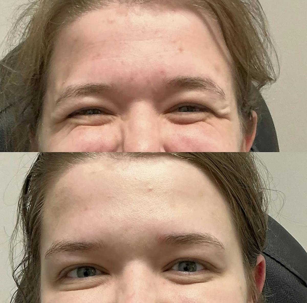 Neurotoxins Before & After Gallery - Patient 666194 - Image 1