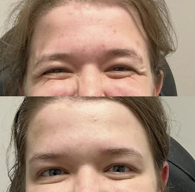 Neurotoxins Before & After Gallery - Patient 666194 - Image 1