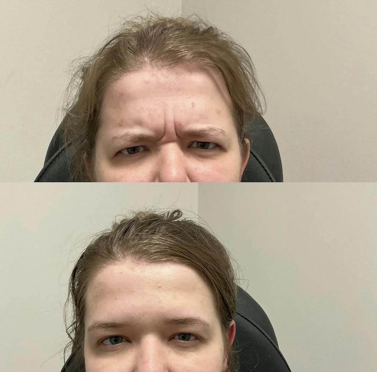 Neurotoxins Before & After Gallery - Patient 666194 - Image 2