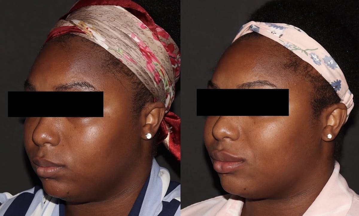 Fillers Before & After Gallery - Patient 340501 - Image 1