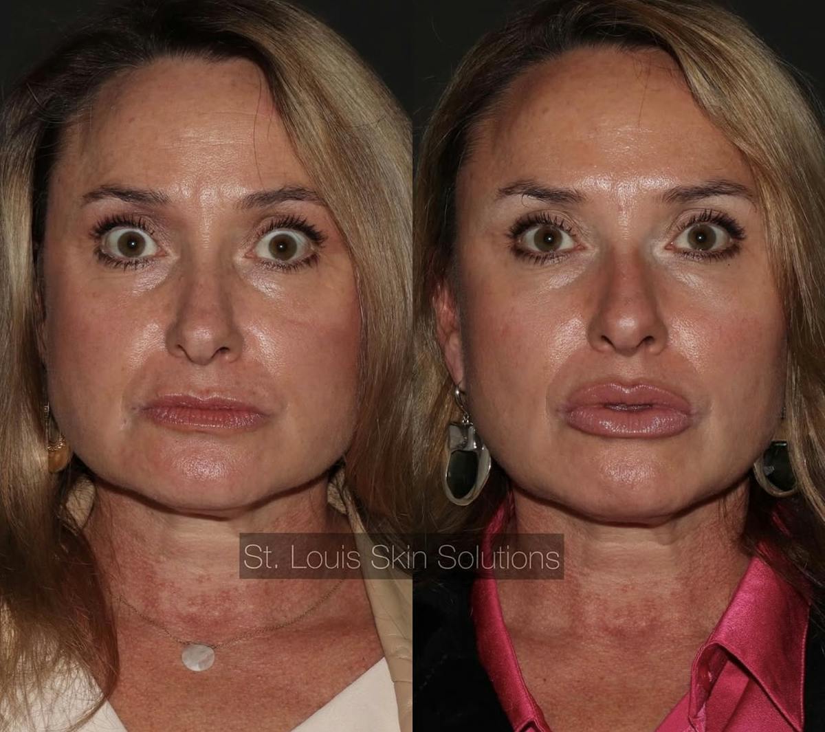 Neurotoxins Before & After Gallery - Patient 252398 - Image 1