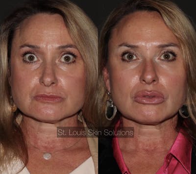 Neurotoxins Before & After Gallery - Patient 252398 - Image 1