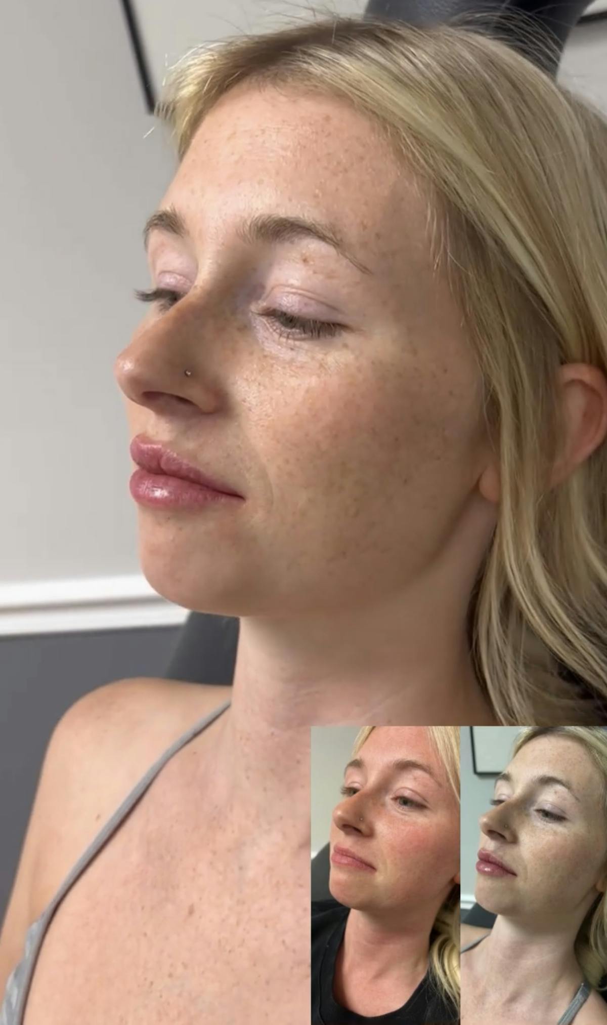 Fillers Before & After Gallery - Patient 771358 - Image 1