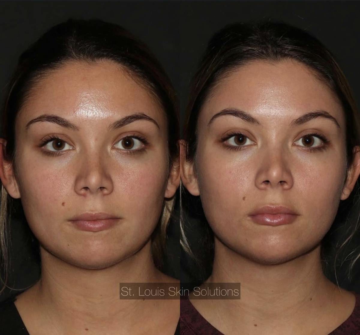Fillers Before & After Gallery - Patient 197048 - Image 1