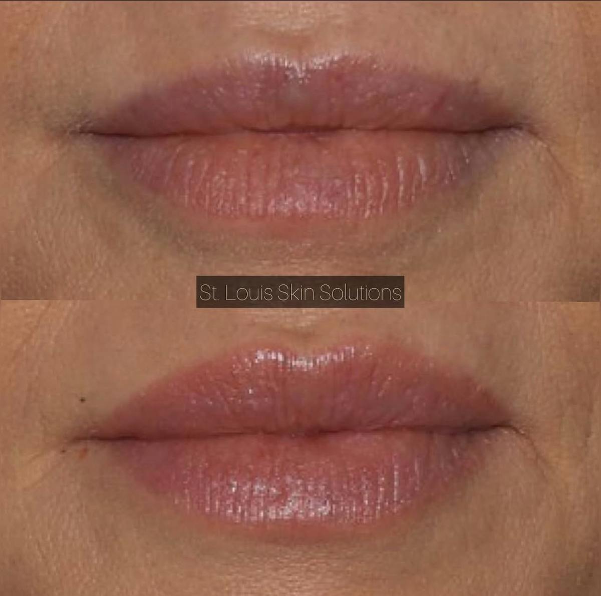 Fillers Before & After Gallery - Patient 763495 - Image 1