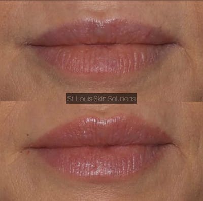 Fillers Before & After Gallery - Patient 763495 - Image 1