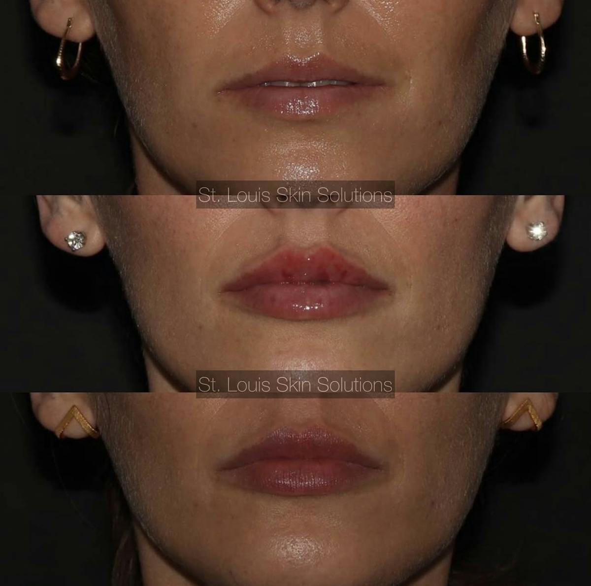 Fillers Before & After Gallery - Patient 262679 - Image 1