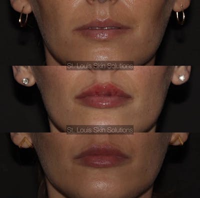 Fillers Before & After Gallery - Patient 262679 - Image 1