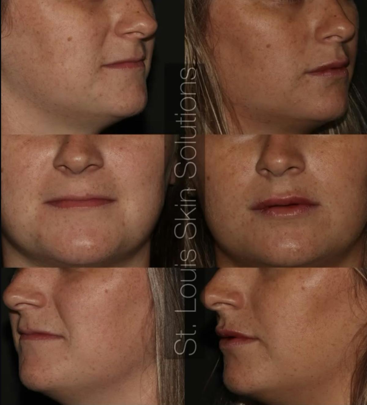Fillers Before & After Gallery - Patient 367265 - Image 1