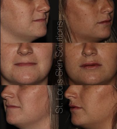Fillers Before & After Gallery - Patient 367265 - Image 1