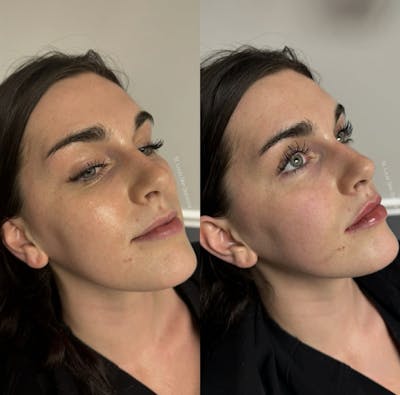 Fillers Before & After Gallery - Patient 295511 - Image 1