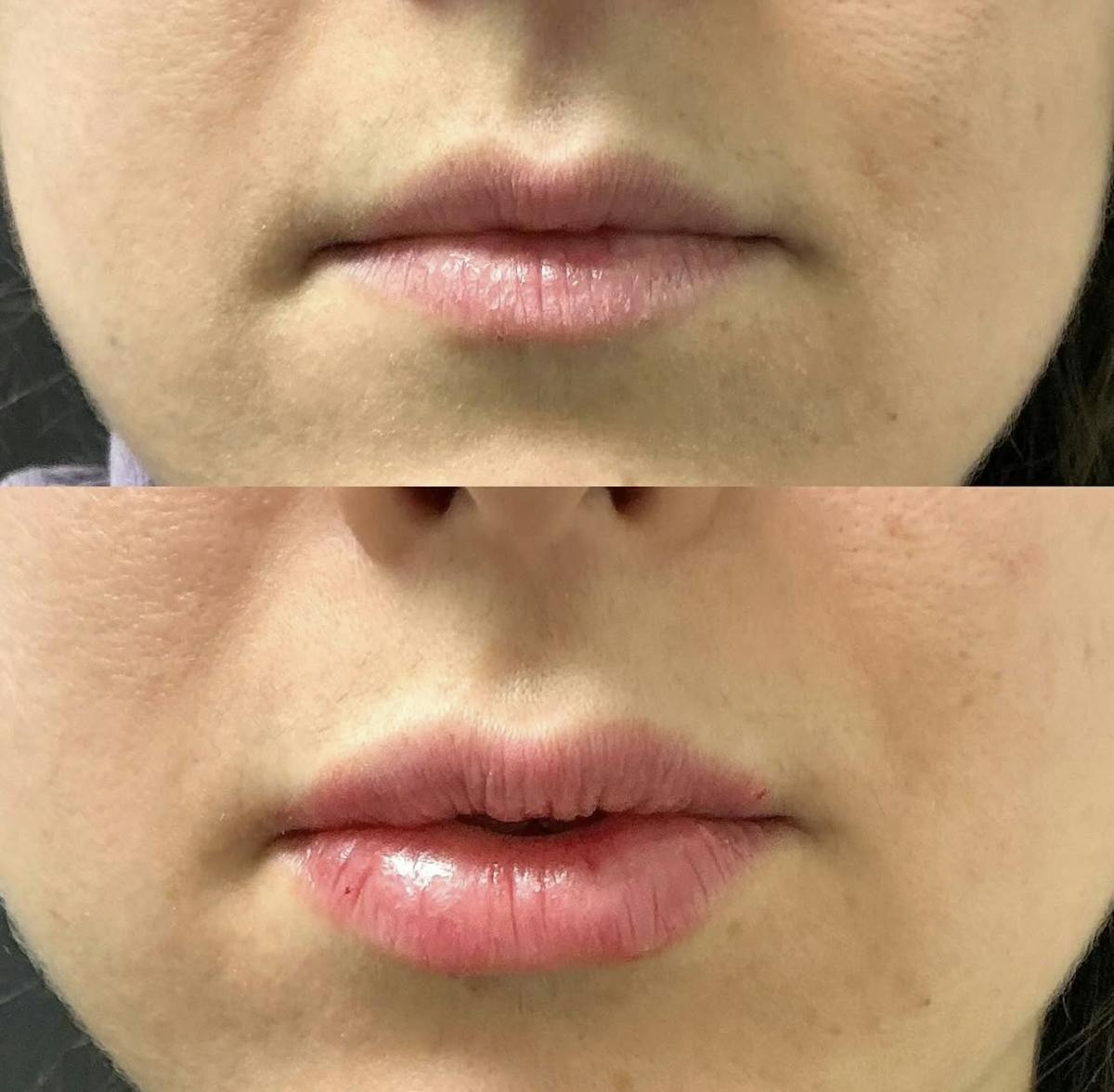 Fillers Before & After Gallery - Patient 194338 - Image 1