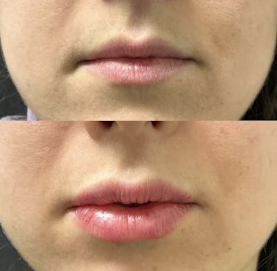 Fillers Before & After Gallery - Patient 194338 - Image 1