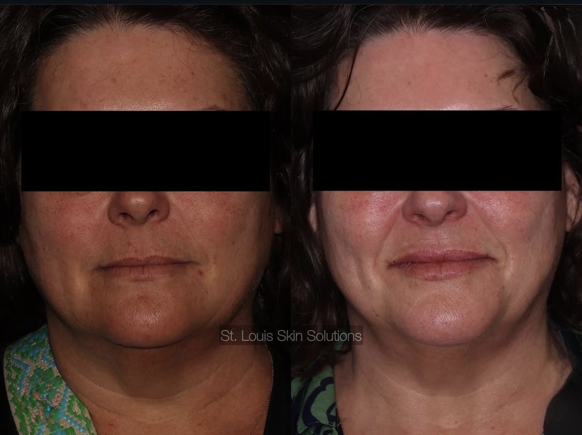 Fillers Before & After Gallery - Patient 313736 - Image 1