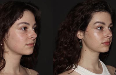 Fillers Before & After Gallery - Patient 211784 - Image 1