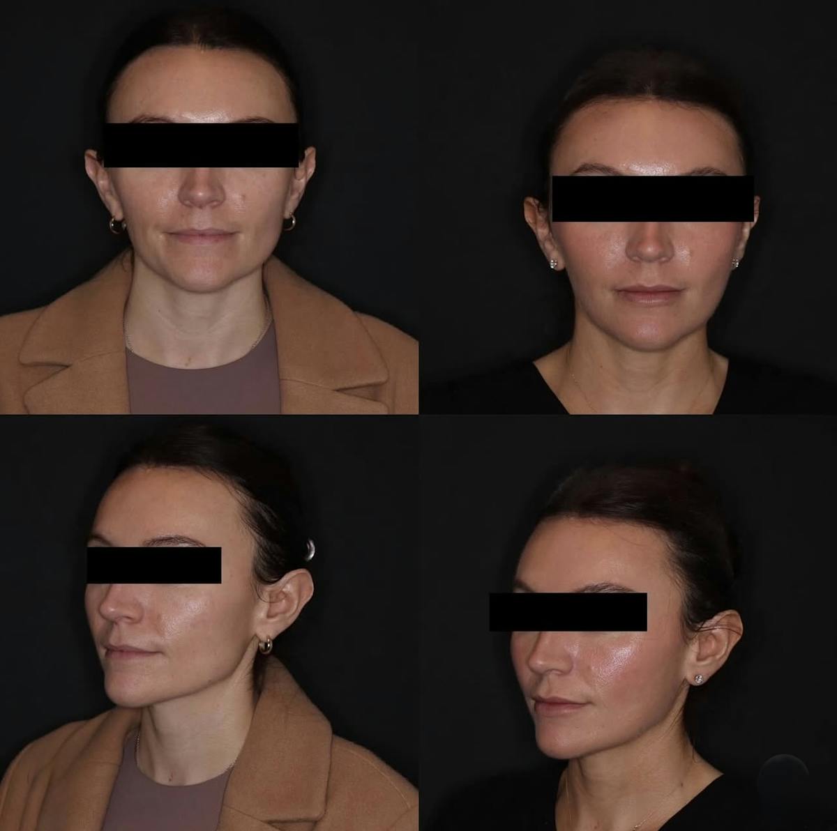 Laser Treatments Before & After Gallery - Patient 395778 - Image 1