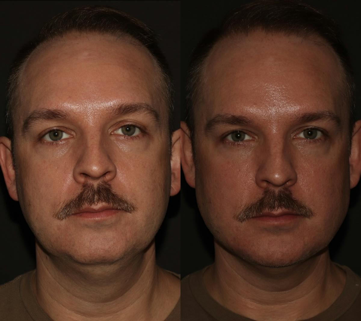 Fillers Before & After Gallery - Patient 416837 - Image 1