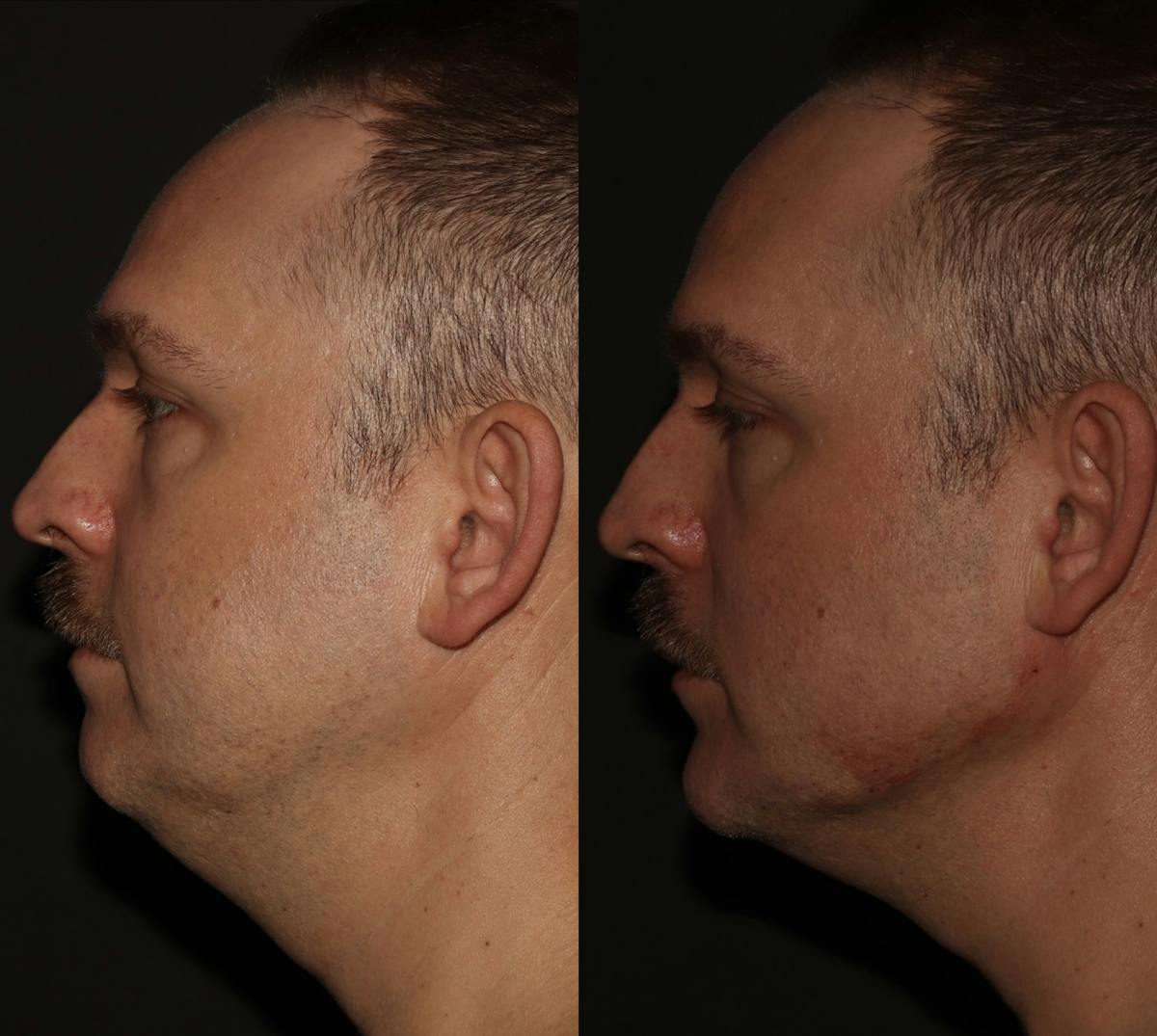 Fillers Before & After Gallery - Patient 416837 - Image 2