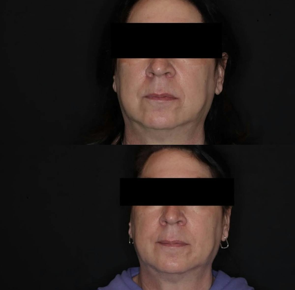 Fillers Before & After Gallery - Patient 383803 - Image 1