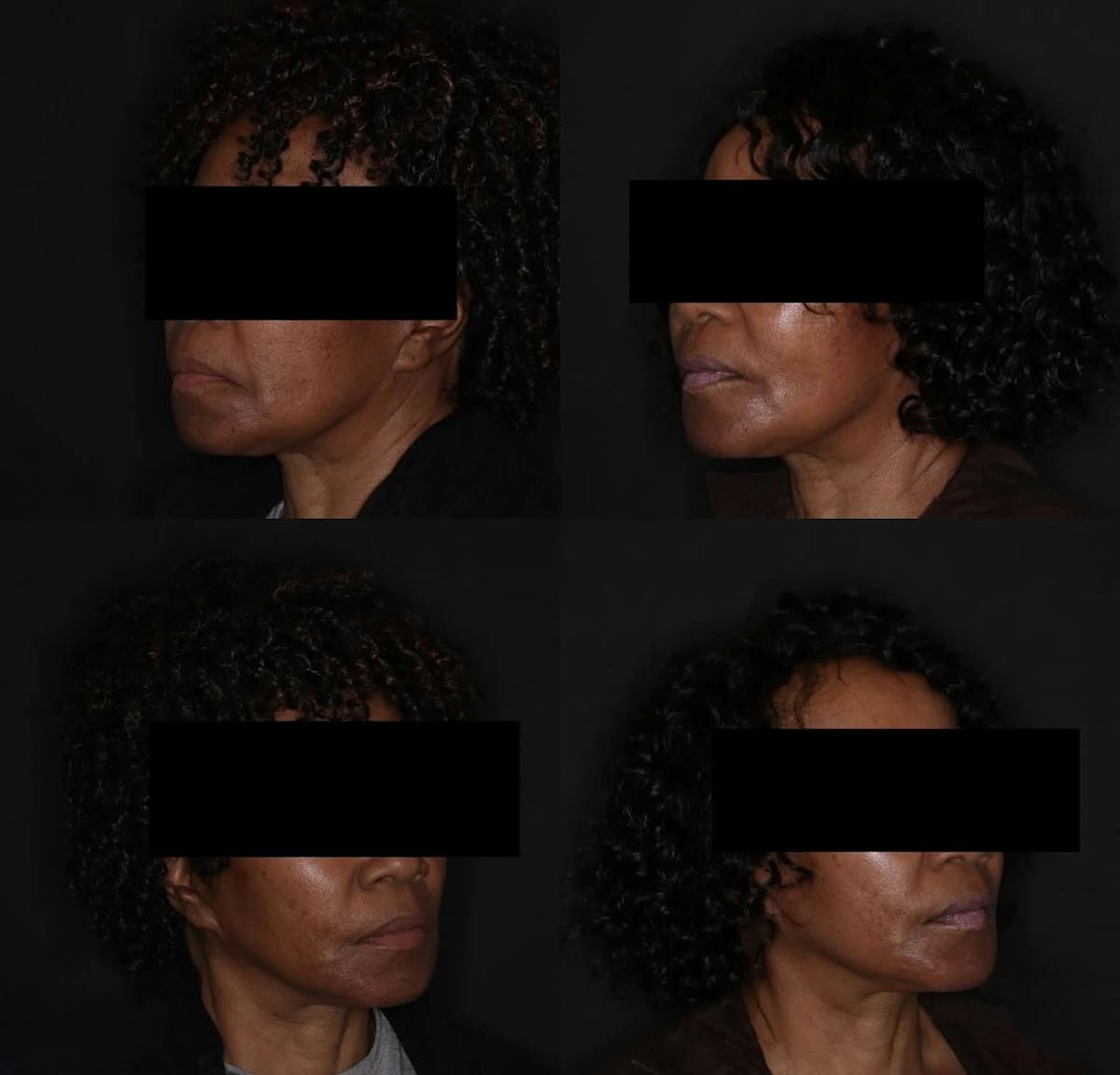 Fillers Before & After Gallery - Patient 310296 - Image 1