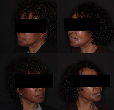 Fillers Before & After Gallery - Patient 310296 - Image 1