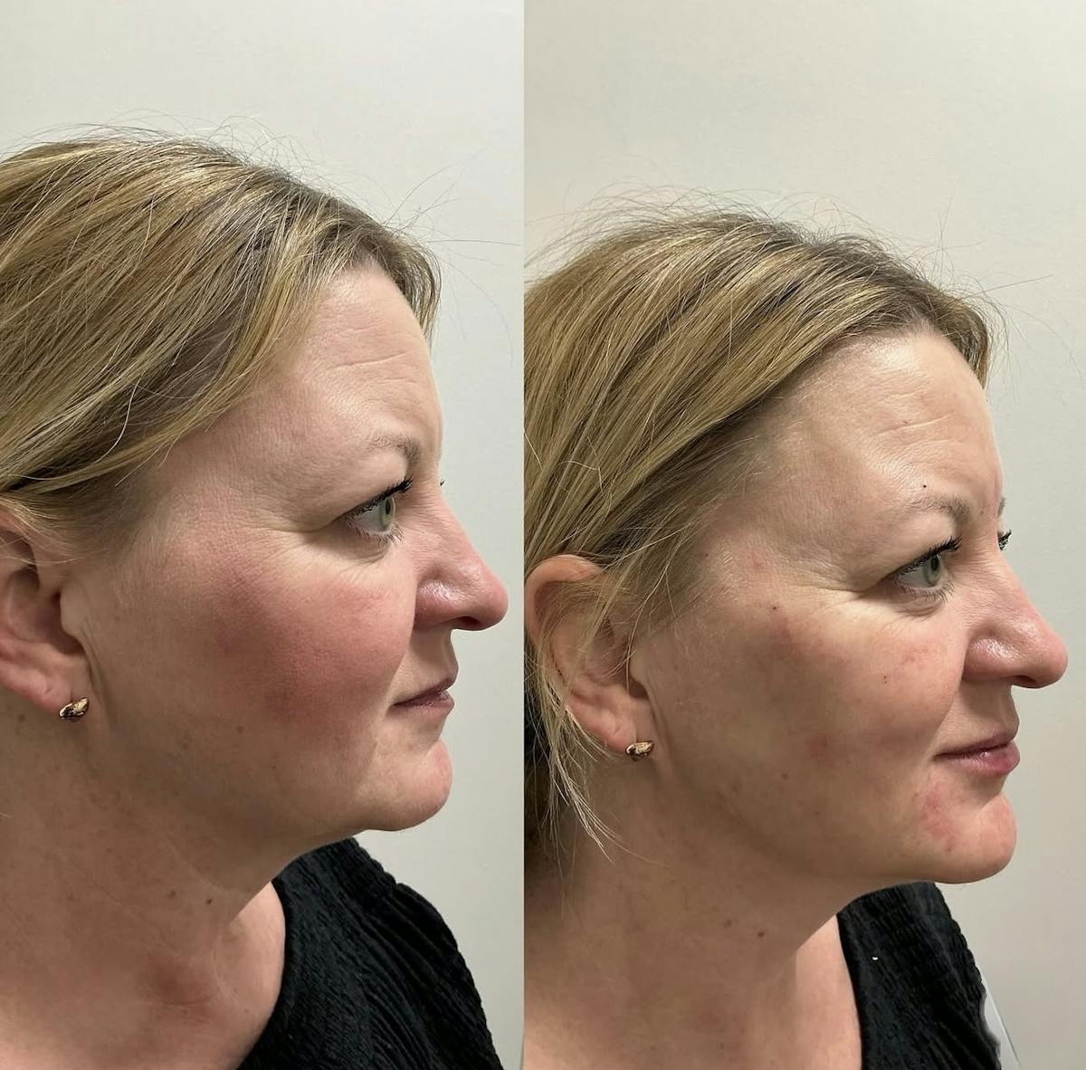 Fillers Before & After Gallery - Patient 194520 - Image 1