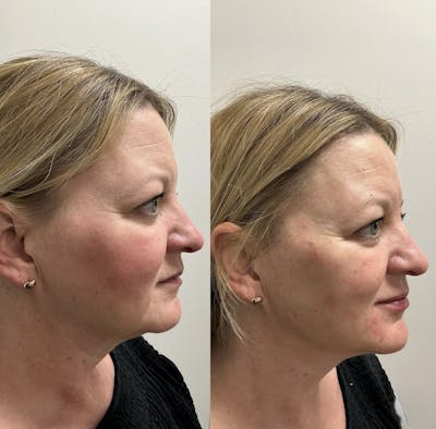 Fillers Before & After Gallery - Patient 194520 - Image 1
