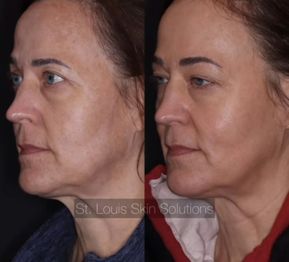 Chemical Peels Before & After Gallery - Patient 162917 - Image 1