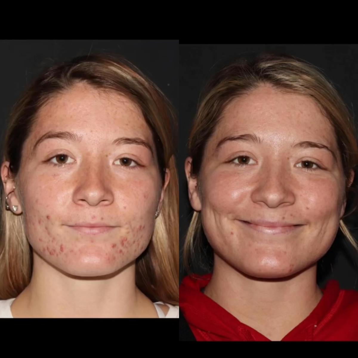 Acne Treatments Before & After Gallery - Patient 375006 - Image 1
