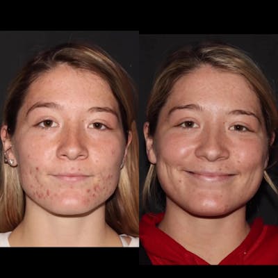 Acne Treatments Before & After Gallery - Patient 375006 - Image 1