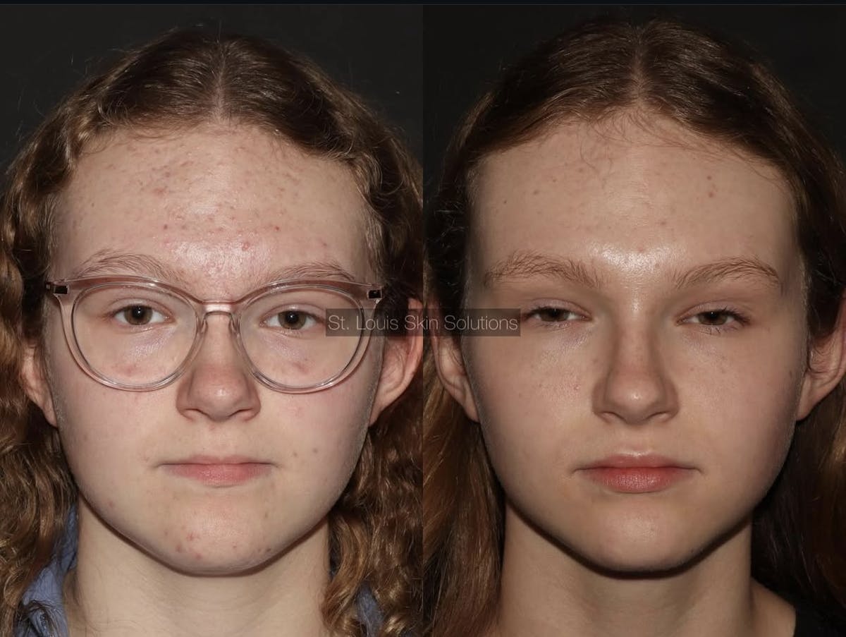 Acne Treatments Before & After Gallery - Patient 315439 - Image 1